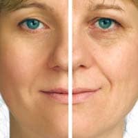 Laser Removal Surgery for Age Spots